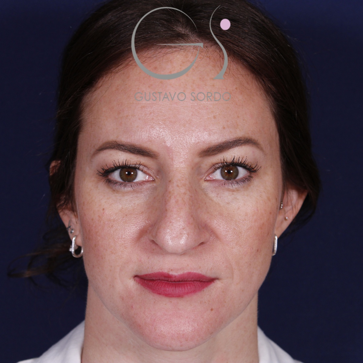 Rinoplastia punta caída, antes de la cirugía — caso operado por el Dr. Gustavo Sordo en Madrid (1)