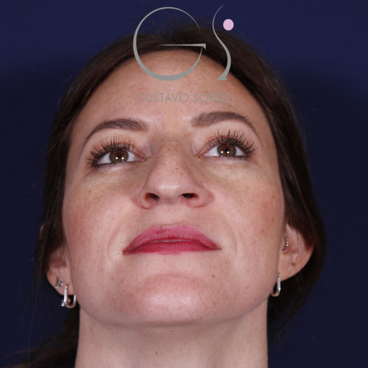 Rinoplastia punta caída, antes de la cirugía — caso operado por el Dr. Gustavo Sordo en Madrid (3)