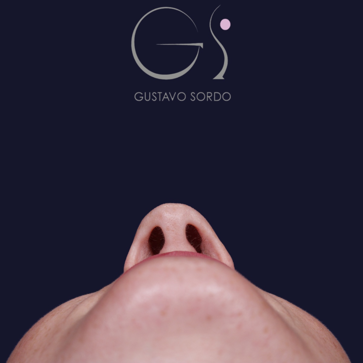 Rinoplastia punta caída, antes de la cirugía — caso operado por el Dr. Gustavo Sordo en Madrid (4)