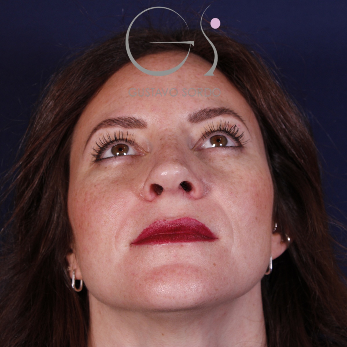 Rinoplastia punta caída, resultado tras la cirugía — caso operado por el Dr. Gustavo Sordo en Madrid (3)