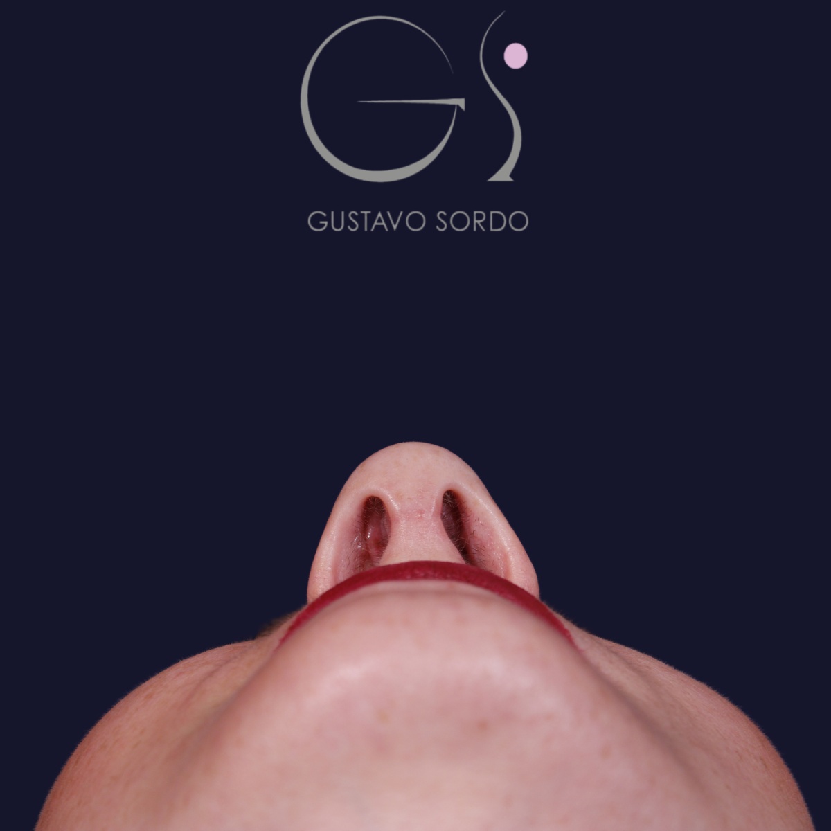 Rinoplastia punta caída, resultado tras la cirugía — caso operado por el Dr. Gustavo Sordo en Madrid (4)