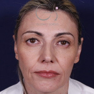 Rinoplastia punta caída larga, antes de la cirugía — caso operado por el Dr. Gustavo Sordo en Madrid (1)