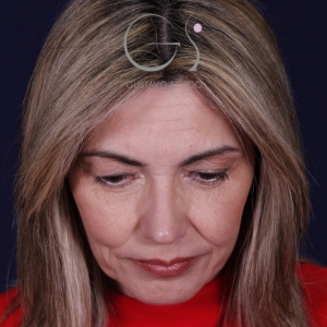 Rinoplastia punta caída larga, resultado tras la cirugía — caso operado por el Dr. Gustavo Sordo en Madrid (2)