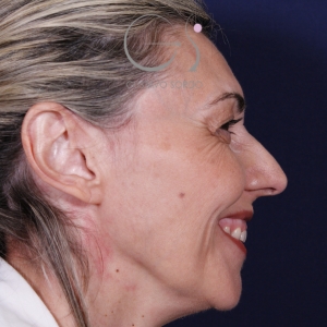 Rinoplastia punta caída larga, antes de la cirugía — caso operado por el Dr. Gustavo Sordo en Madrid (3)