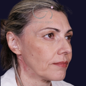 Rinoplastia punta caída larga, antes de la cirugía — caso operado por el Dr. Gustavo Sordo en Madrid (4)