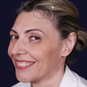 Rinoplastia punta caída larga, antes de la cirugía — caso operado por el Dr. Gustavo Sordo en Madrid (5)