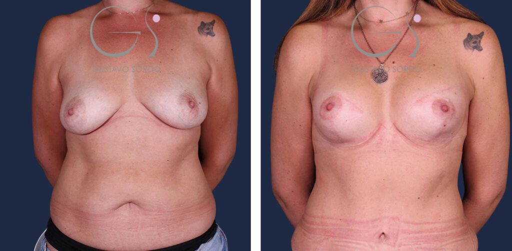 Abdominoplastia: antes y después de un caso operado en Madrid
