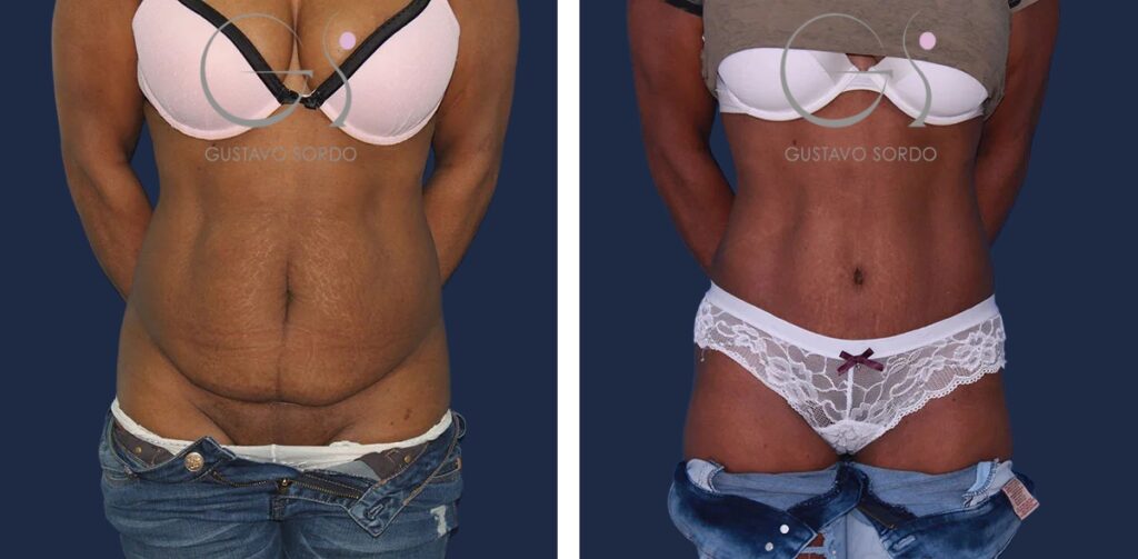 Abdominoplastia: antes y después de un caso operado en Madrid