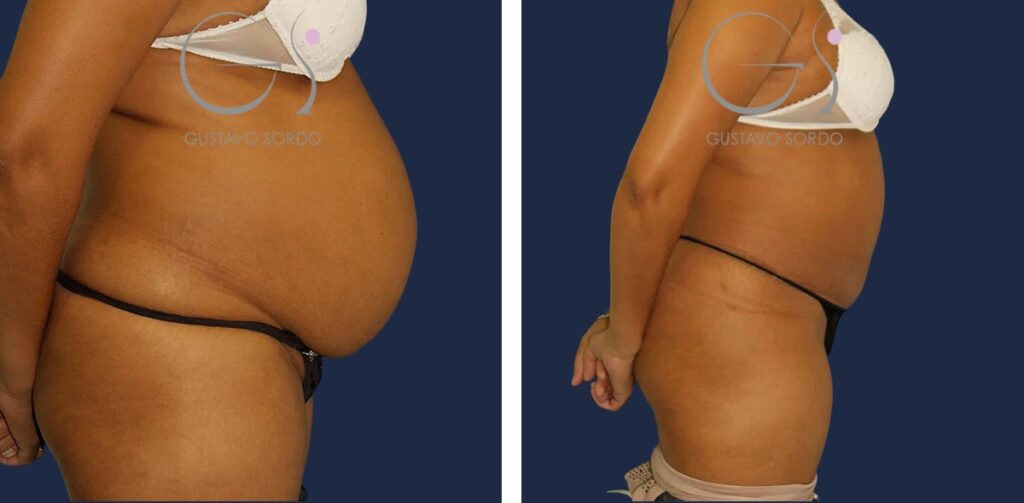 Abdominoplastia: antes y después de un caso operado en Madrid