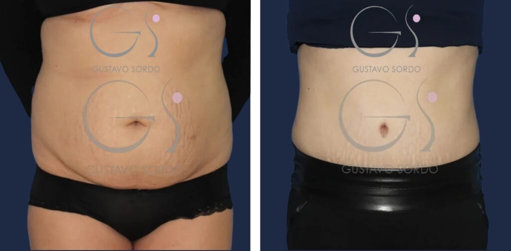 Abdominoplastia: antes y después de un caso operado en Madrid