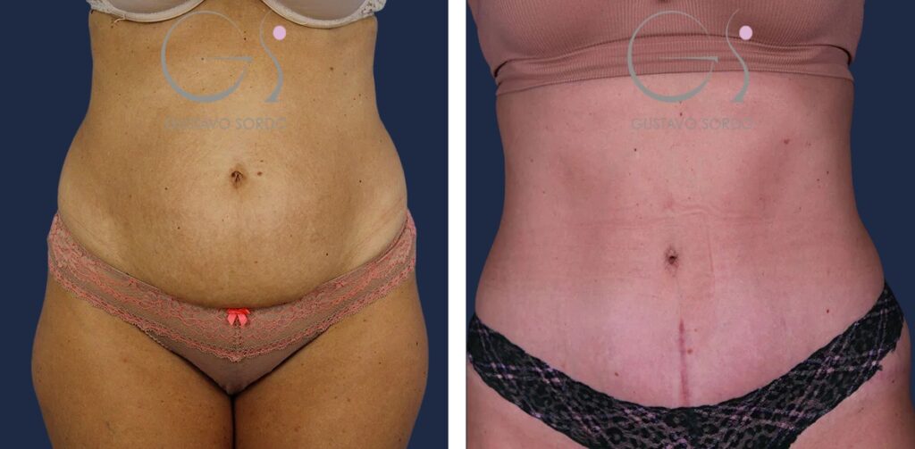 Abdominoplastia: antes y después de un caso operado en Madrid