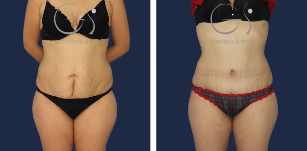 Abdominoplastia: antes y después de un caso operado en Madrid
