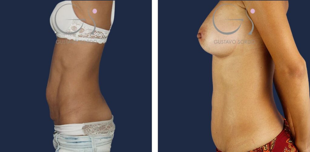 Abdominoplastia: antes y después de un caso operado en Madrid