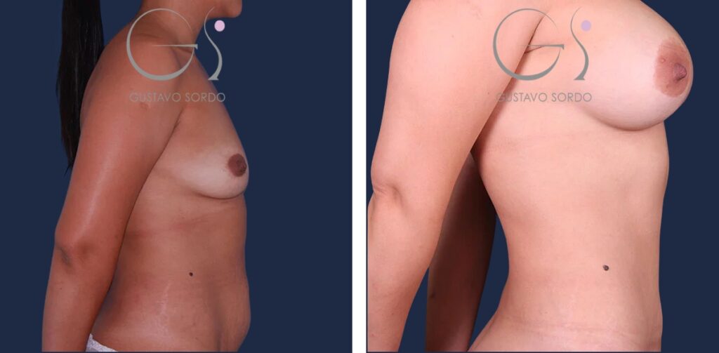 Abdominoplastia: antes y después de un caso operado en Madrid