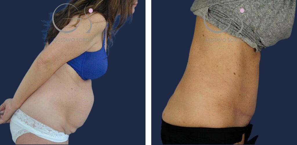 Abdominoplastia: antes y después de un caso operado en Madrid
