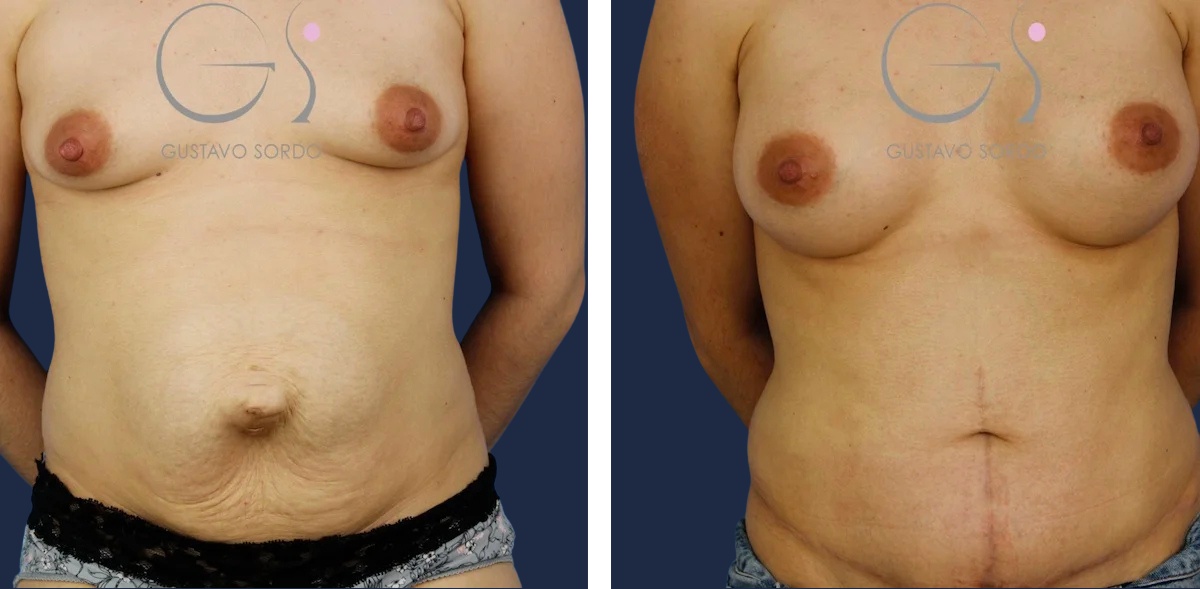 Abdominoplastia: antes y después de un caso operado por el Dr. Gustavo Sordo en Madrid