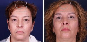 Blefaroplastia: antes y después de un caso operado en Madrid
