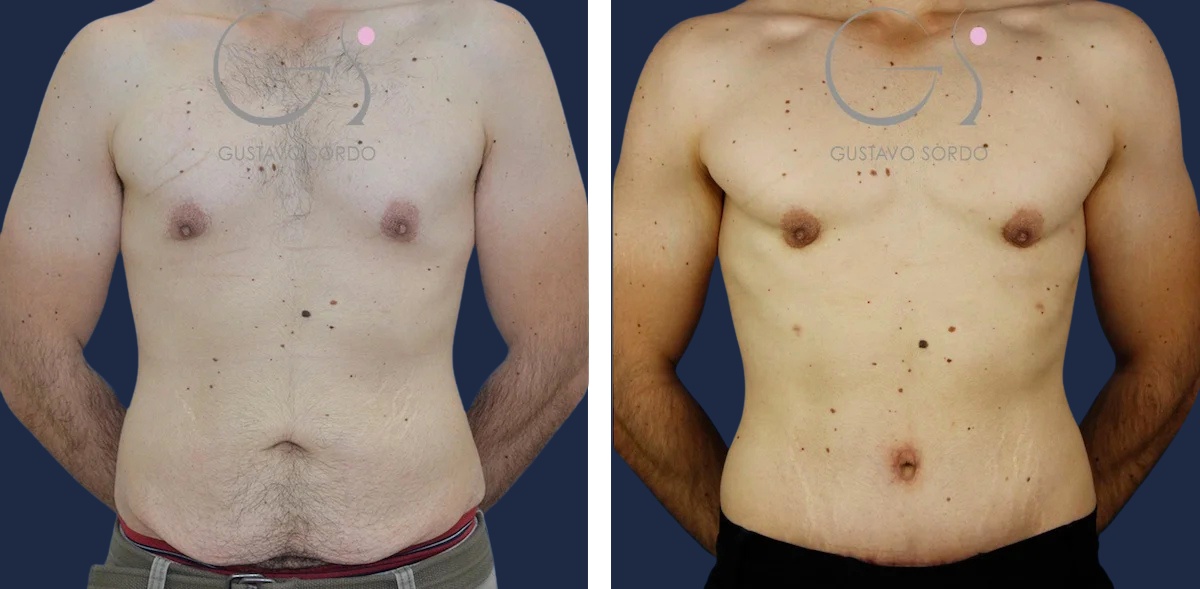 Abdominoplastia: antes y después de un caso operado por el Dr. Gustavo Sordo en Madrid
