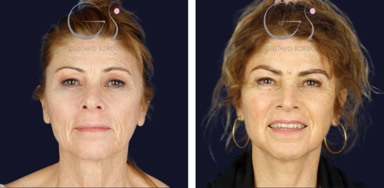 Blefaroplastia: antes y después de un caso operado en Madrid