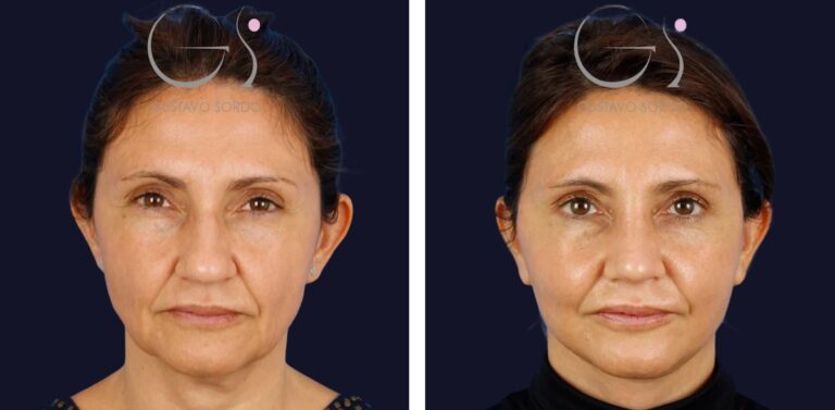 Lifting facial y rinoplastia: antes y después de un caso operado por el Dr. Gustavo Sordo en Madrid
