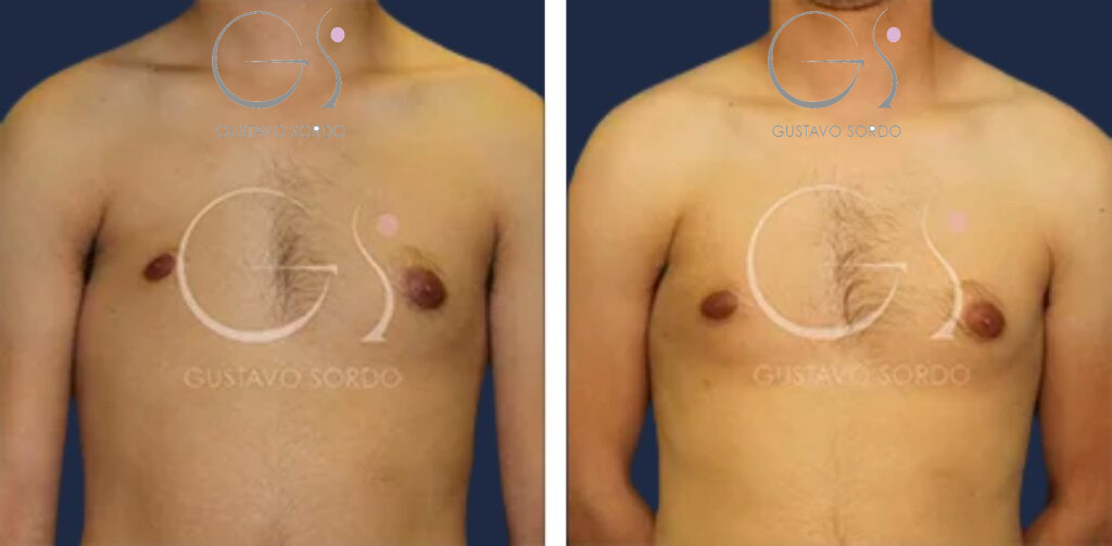 Lipotransferencia de grasa — en hombre: antes y después de un caso operado en Madrid