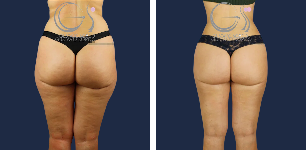 Liposucción: antes y después de un caso operado por el Dr. Gustavo Sordo en Madrid