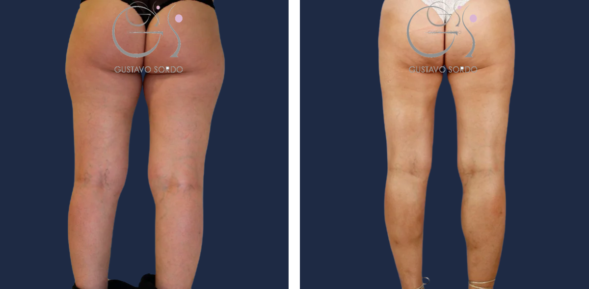 Lipofilling: antes y después de un caso operado por el Dr. Gustavo Sordo en Madrid