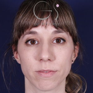 Rhinoplastie ultrasonique, avant l'intervention chirurgicale — cas opéré par le Dr Gustavo Sordo à Madrid (1)