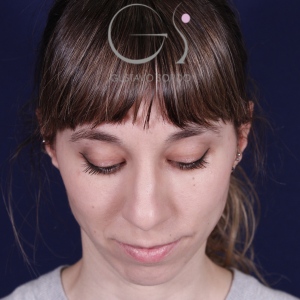 Rhinoplastie ultrasonique, avant l'intervention chirurgicale — cas opéré par le Dr Gustavo Sordo à Madrid (2)