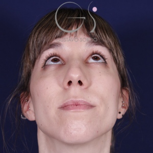 Rhinoplastie ultrasonique, avant l'intervention chirurgicale — cas opéré par le Dr Gustavo Sordo à Madrid (3)