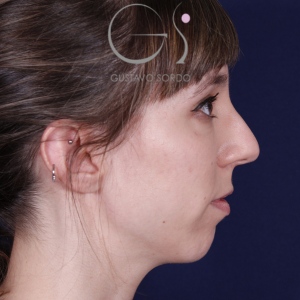 Rhinoplastie ultrasonique, avant l'intervention chirurgicale — cas opéré par le Dr Gustavo Sordo à Madrid (5)