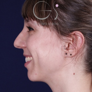 Rhinoplastie ultrasonique, avant l'intervention chirurgicale — cas opéré par le Dr Gustavo Sordo à Madrid (4)