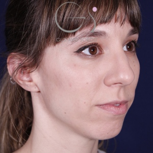 Rhinoplastie ultrasonique, avant l'intervention chirurgicale — cas opéré par le Dr Gustavo Sordo à Madrid (6)