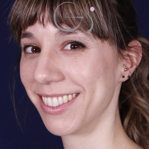 Rhinoplastie ultrasonique, avant l'intervention chirurgicale — cas opéré par le Dr Gustavo Sordo à Madrid (7)