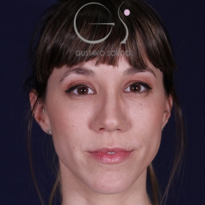 Rhinoplastie ultrasonique, résultat après intervention chirurgicale — cas opéré par le Dr Gustavo Sordo à Madrid (1)