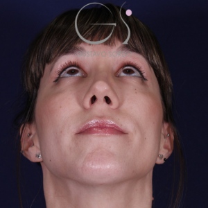 Rhinoplastie ultrasonique, résultat après intervention chirurgicale — cas opéré par le Dr Gustavo Sordo à Madrid (3)