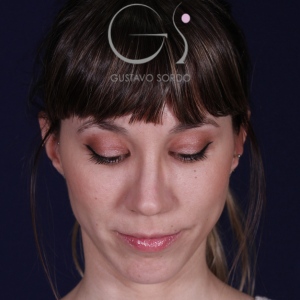 Rhinoplastie ultrasonique, résultat après intervention chirurgicale — cas opéré par le Dr Gustavo Sordo à Madrid (2)