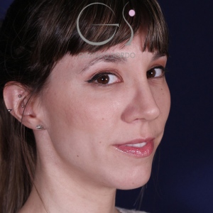 Rhinoplastie ultrasonique, résultat après intervention chirurgicale — cas opéré par le Dr Gustavo Sordo à Madrid (6)