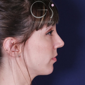Rhinoplastie ultrasonique, résultat après intervention chirurgicale — cas opéré par le Dr Gustavo Sordo à Madrid (5)