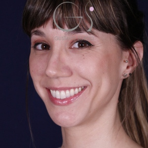 Rhinoplastie ultrasonique, résultat après intervention chirurgicale — cas opéré par le Dr Gustavo Sordo à Madrid (7)