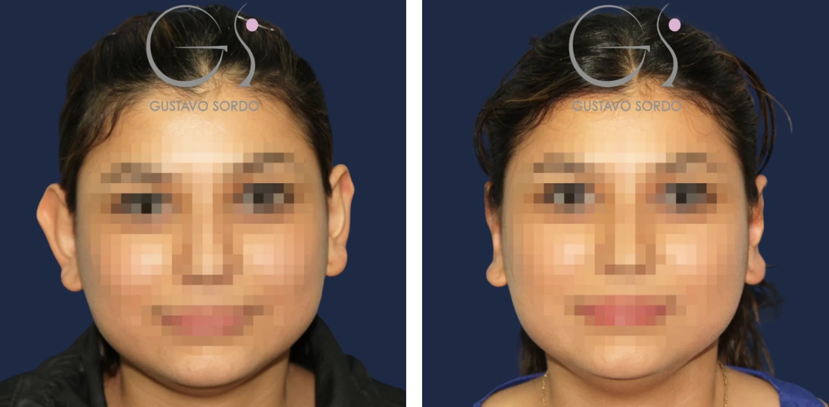 Otoplastia: antes y después de un caso operado por el Dr. Gustavo Sordo en Madrid