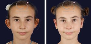 Otoplastia niña infantil: antes y después de un caso operado en Madrid