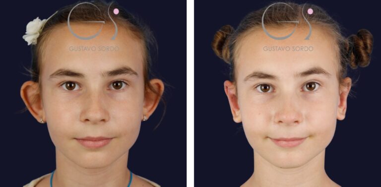 Otoplastia niña infantil: antes y después de un caso operado en Madrid