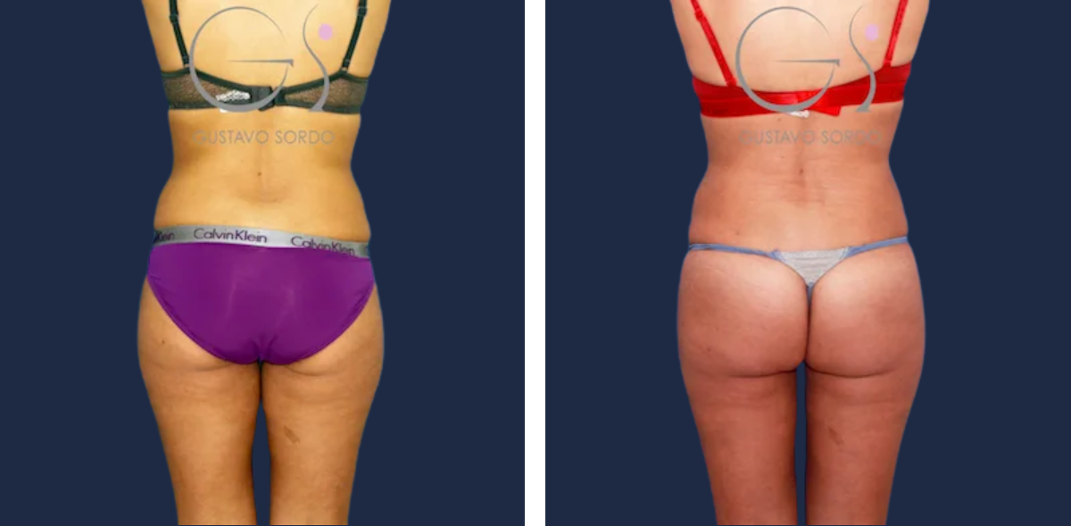 Lipofilling: antes y después de un caso operado por el Dr. Gustavo Sordo en Madrid