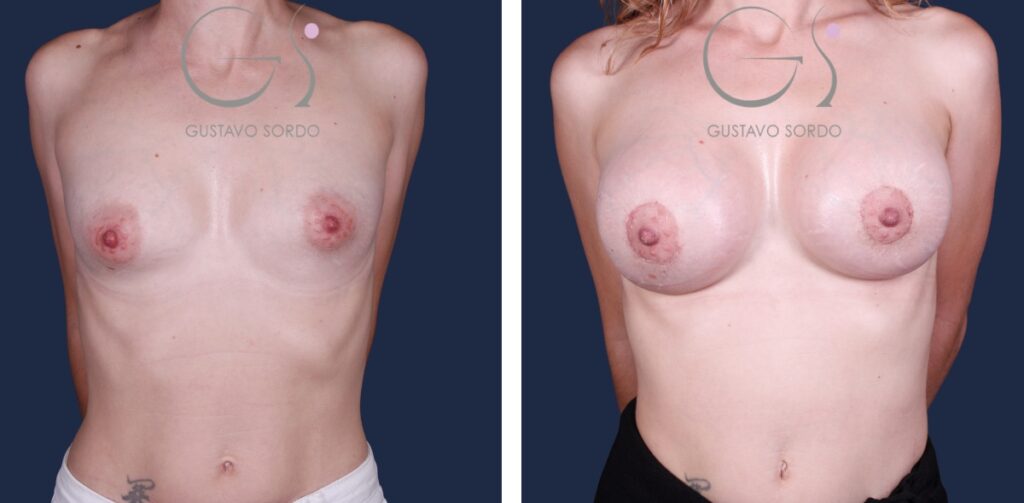 Reducción de mamas con autoprótesis y lipofilling: antes y después de un caso operado por el Dr. Gustavo Sordo en Madrid
