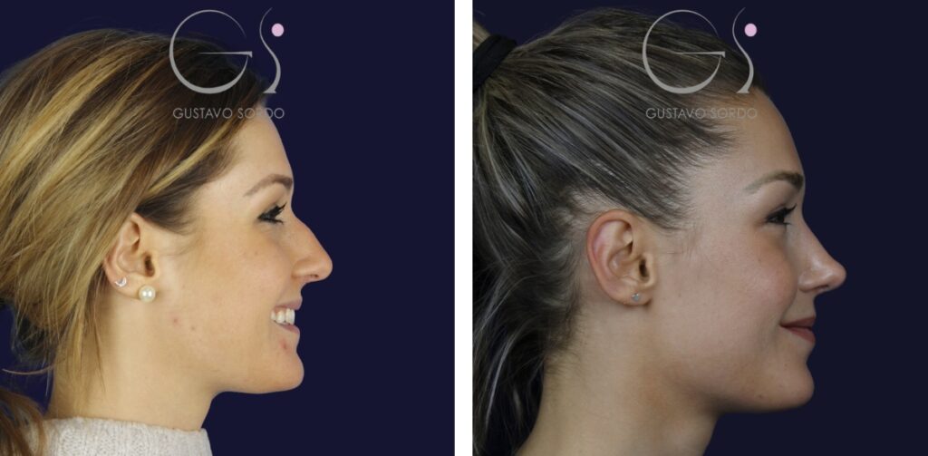 Rhinoplastie — nez retroussé&nbsp;: avant et après une intervention réalisée à Madrid
