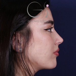 Antes y después de rinoplastia, Dr. Gustavo Sordo