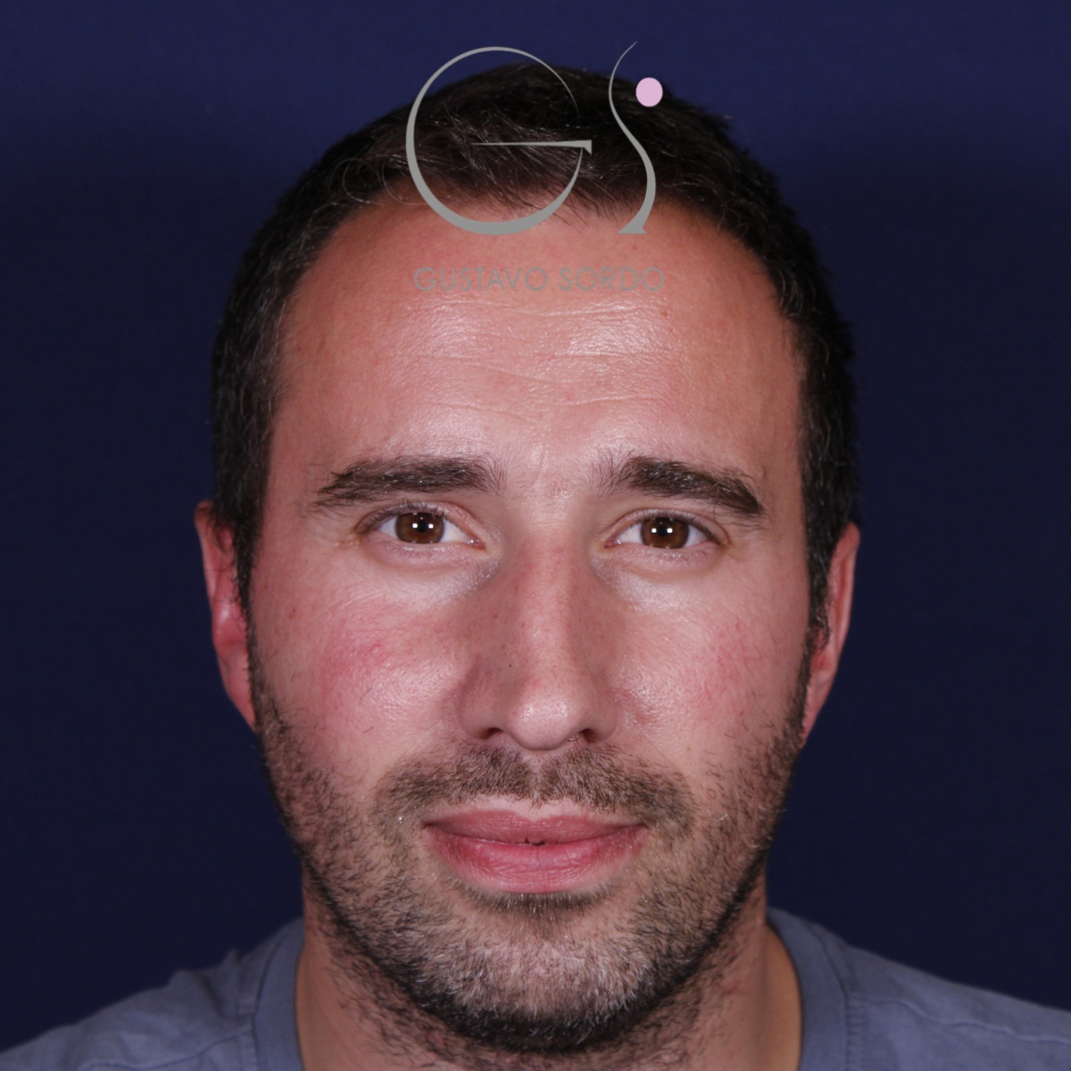 Rinoplastia con mentoplastia en hombre, antes de la operación (1)