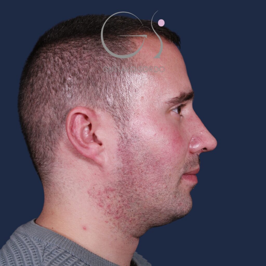 Rinoplastia con mentoplastia en hombre, después de la operación (3)
