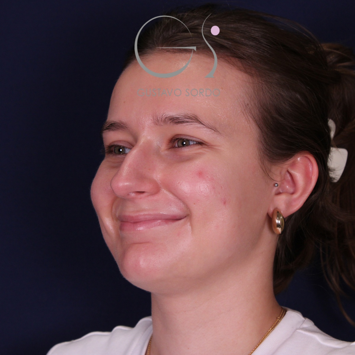 Rinoplastia en nariz aguileña con giba y punta caída, semiperfil izquierdo sonriendo: antes de la operación